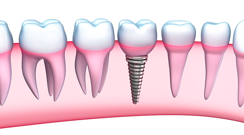 implante dental en don benito
