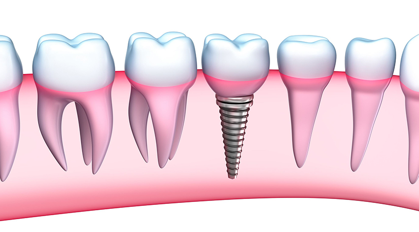 implante dental en don benito